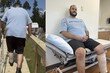 바닷물 속 ‘살을 먹는 박테리아’…美 30대 남성 사투 끝 다리 절단