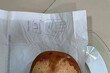“신생아 무게와 맞먹었다”…스리랑카 환자 방광서 3.1㎏ 초대형 결석