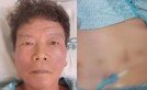 ‘전립샘암 투병’ 문경민 근황…후유증에 기저귀를