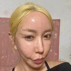44세 S.E.S. 슈, 얼굴 가득 피딱지…적나라한 셀카 [DA★]