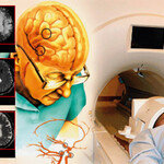 무증상 뇌경색 초기에 잡아라!