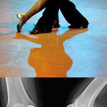 관절 ‘부분 교체’로 무릎이 춤춘다
