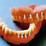 임플란트와 틀니의 운명적 만남