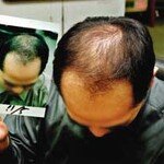 탈모 치료 미루면 더 훤해진다