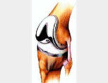 퇴행성 관절염의 대안 ‘인공관절’