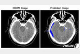 AI로 수초 안에 뇌출혈 분석…“골든타임 사수”