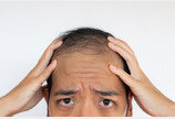 “살 빼려다 다른게 빠졌다”…탈모 위험 50%↑, 뭐길래?