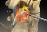 “인위적 디스크 제거 없이 통증 완화… 추간공확장술로 척추질환 해결”