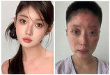 담뱃불에 가스 ‘펑’…전신화상 입은 中 뷰티 인플루언서