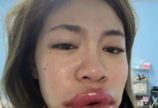 입술 필러 맞고 ‘모다피’ 됐다? 태국 여성의 눈물 고백