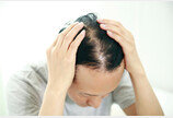 1000만 탈모인의 희망?…“지방줄기세포, 모낭기능 회복 긍정영향”