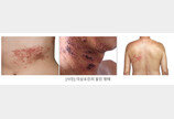 “감기 몸살인줄 알았는데 대상포진”…골든타임은 72시간