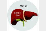 “불가능” 판정 환자도 수술… 생체 ‘간이식’ 1년 생존율 95%