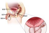 ‘침묵의 살인자’ 전립선암…50대이상 남성 ‘이 검사’ 필수