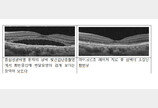 시야 중심 뿌얘지는 ‘중심성망막염’…‘이 치료’ 효과 입증