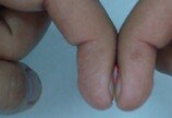 손톱 붙였는데 ‘이 틈’ 없으면…폐암 초기 징후 ‘의심’
