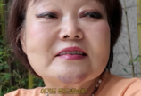‘빅마마’ 이혜정, 낙상으로 턱에 검푸른 피멍…대처 어떻게?