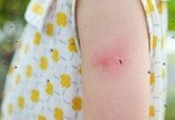 “서울서도 걸린다”…여름철 말라리아, 감기와 뭐가 다를까