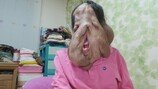 섬유종 앓는女, 눈으로 봐도 믿을 수 없는 얼굴