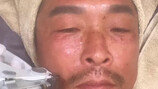 추성훈 노화 방지 시술…비주얼 쇼크