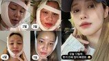 유깻잎, 성형 수술 13일차 얼굴 공개…다소 충격적