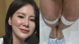 ‘♥안정환’ 이혜원, 얼굴 갈아먹은 근황 “SOS”…부상 상태 보니