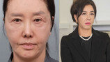 유혜리, 안면거상 시술 후 근황…세상 놀란 비주얼
