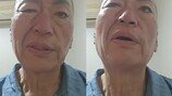 ‘결혼 8번’ 유퉁, 입 돌아가고 눈 안 감겨…안면마비 심각