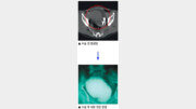[헬스&뷰티/Before & After]방광대치수술
