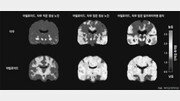 혈액-게놈-인공지능까지 활용… 치매 조기발견에 연구 사활