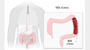 완치 어려운 질환… 방치하면 대장암 위험[홍은심 기자의 긴가민가 질환시그널]