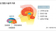 젓가락질 어려울 만큼 손이 ‘덜덜’… 수전증 치료법은?[홍은심 기자의 긴가민가 질환시그널]