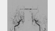 비정상적 뇌혈관이 연기 피어오르듯… 여성에 두배 많아 [홍은심 기자의 긴가민가 질환시그널]