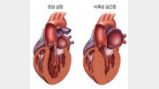 운동 중 지나치게 숨 차다면 비후성 심근병증 의심을[홍은심 기자의 긴가민가 질환시그널]