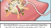 [만화 그리는 의사들]〈315〉간암의 치료-방사선색전술