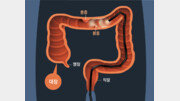 ‘조용한 살인자’ 대장암 급증… “대장 내시경, 암 검진 기본 검사로”