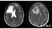 “갑자기 멍∼하고, 두통까지”… 건망증 아닌 뇌종양 신호일 수 있다[이진형의 뇌, 우리 속의 우주]