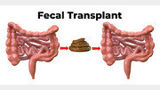 건강한 사람의 대변 이식, 암 치료의 ‘새 돌파구’ 될까