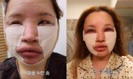 라뮤끄, 얼굴 지방 긁어내고 극심한 고통 ‘상태 심각’