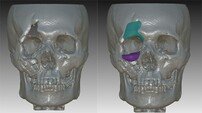 고대안암병원, 안면골 및 두개골 결손 치료 3D프린터 