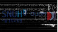 서울대병원, 이미지 기반 수면 단계 자동판독 알고리즘 개발 