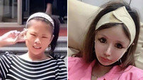 7억 들여 100번 성형한 10대女 ‘수술 중단’ 선언