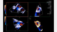 중앙대광명병원, 국내 최초 4D 심장내초음파 활용 경피적 대동맥판막 삽입술 성공