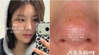 권은비, 킬리만자로 등반 후 코·입술 2도 화상…“내 코 돌아왔다”