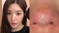 권은비, 코·입술 2도 화상 충격 “제 얼굴…놀라셨죠”