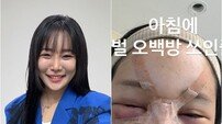 랄랄, 눈밑지방 재배치+코 수술…“벌 500방 맞은 느낌” 고백