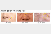 고대안암병원 “점·검버섯, 육안 감별 어려운 피부암 주의”