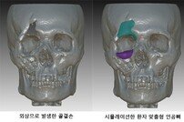 고대안암병원, 안면골 및 두개골 결손 치료 3D프린터