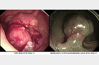 증상 없는 대장암, 주기적인 대장 내시경 검사로 예방해야 [건강 올레길]
