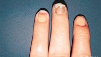 [홍은심 기자의 긴가민가 질환시그널]손발톱 변형 땐 ‘건선’ 의심… 방치하면 관절염 생길수도